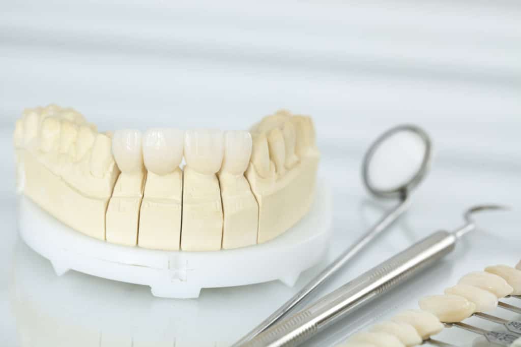 porcelain veneers clear lake