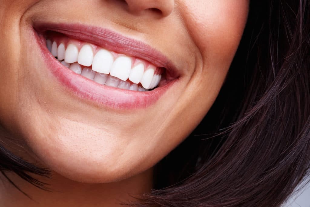 porcelain veneers