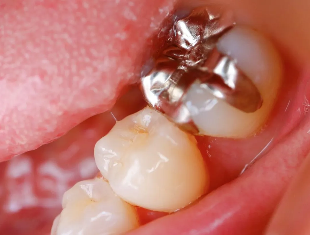 composite fillings
