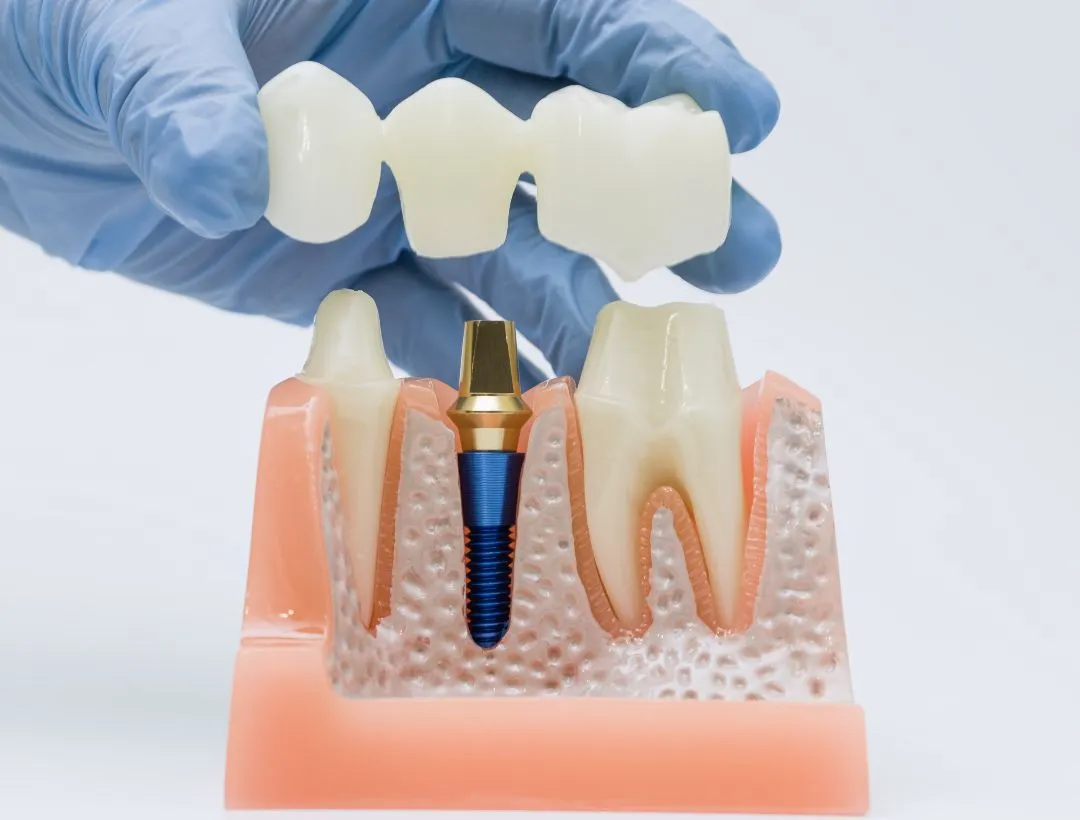 dental crowns