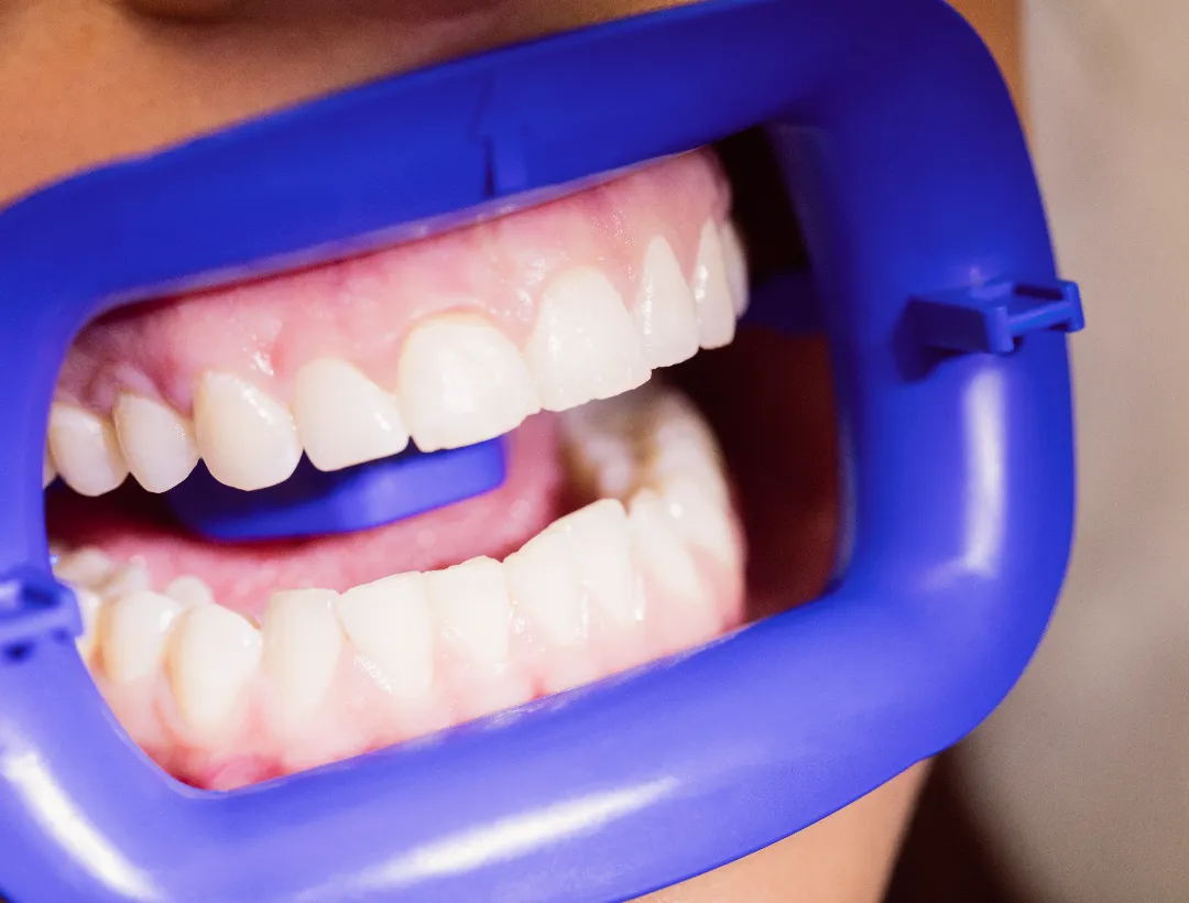 gum contouring cosmetic dentesty