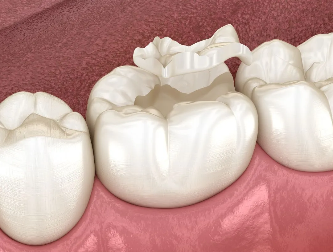 inlay and onlay restorations