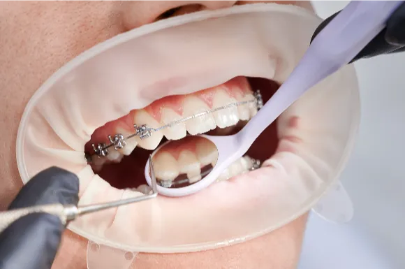 orthodontics at clear lake dental care