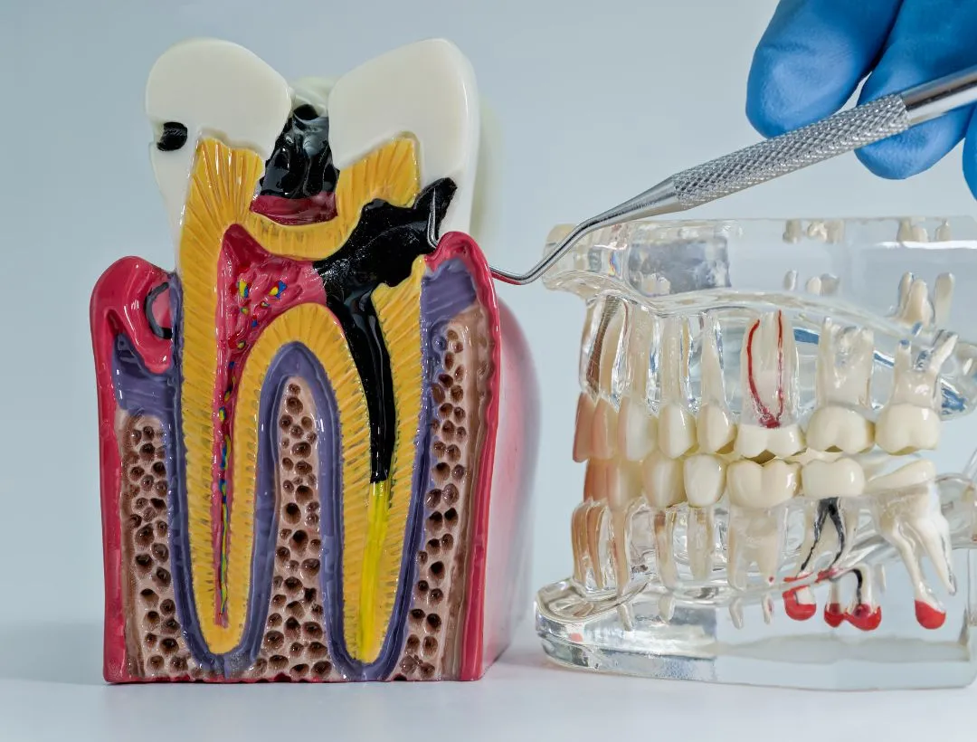 root canal retreatment