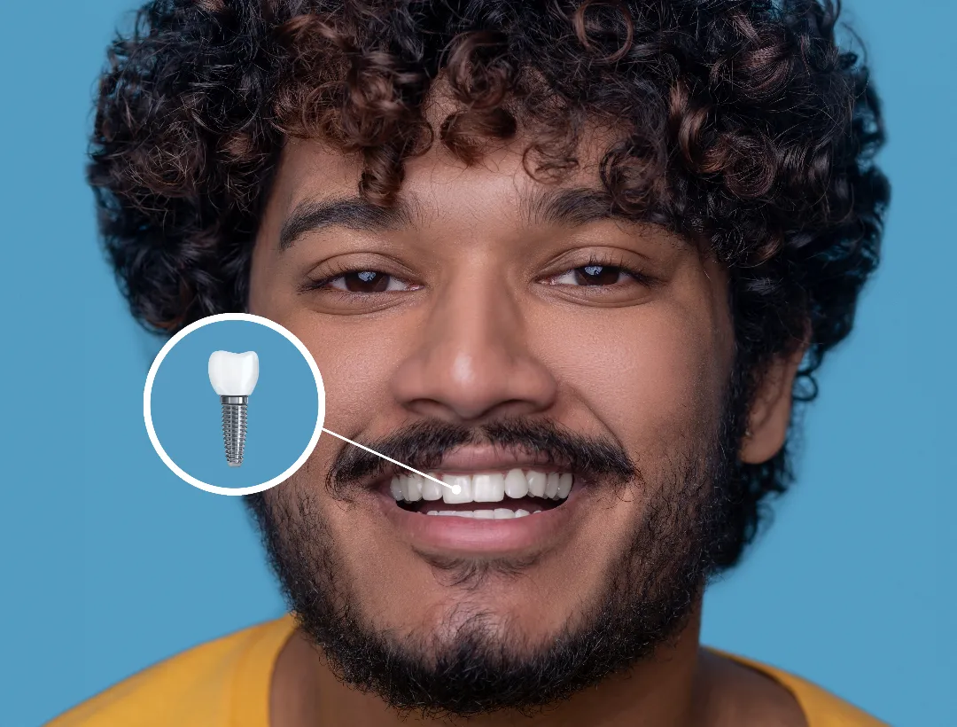 single tooth implant