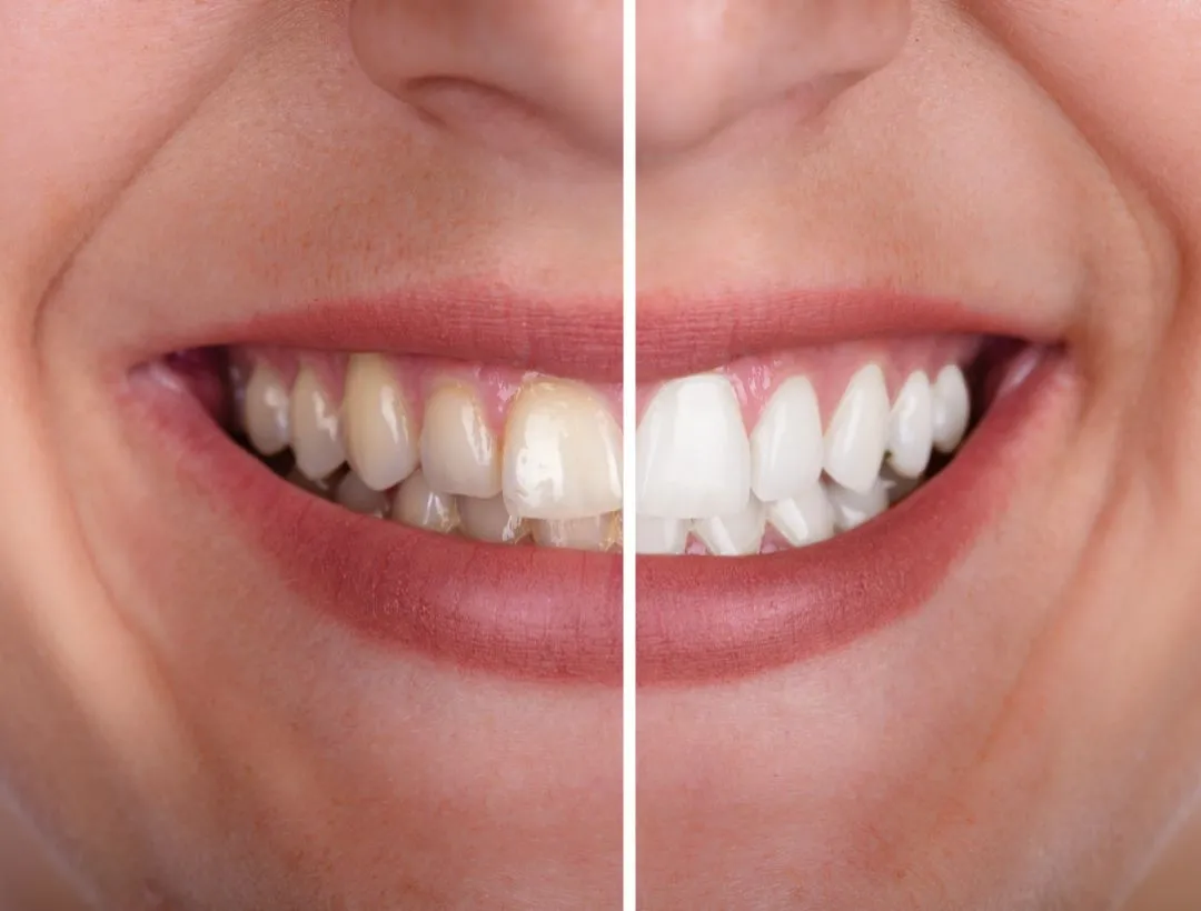 teeth whitening 1
