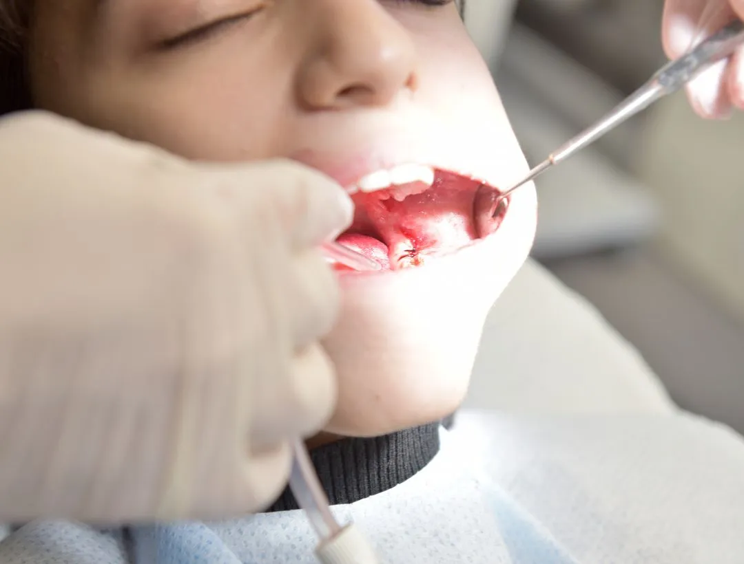 wisdom tooth removal